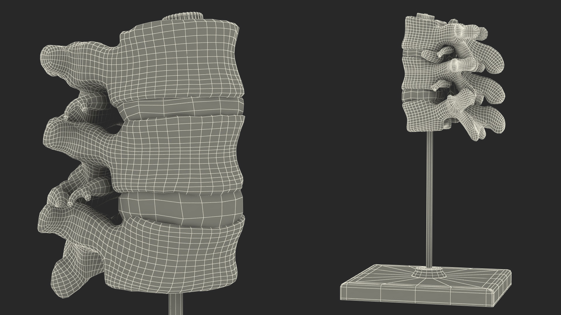 3D Herniated Vertebrae on Medical Stand