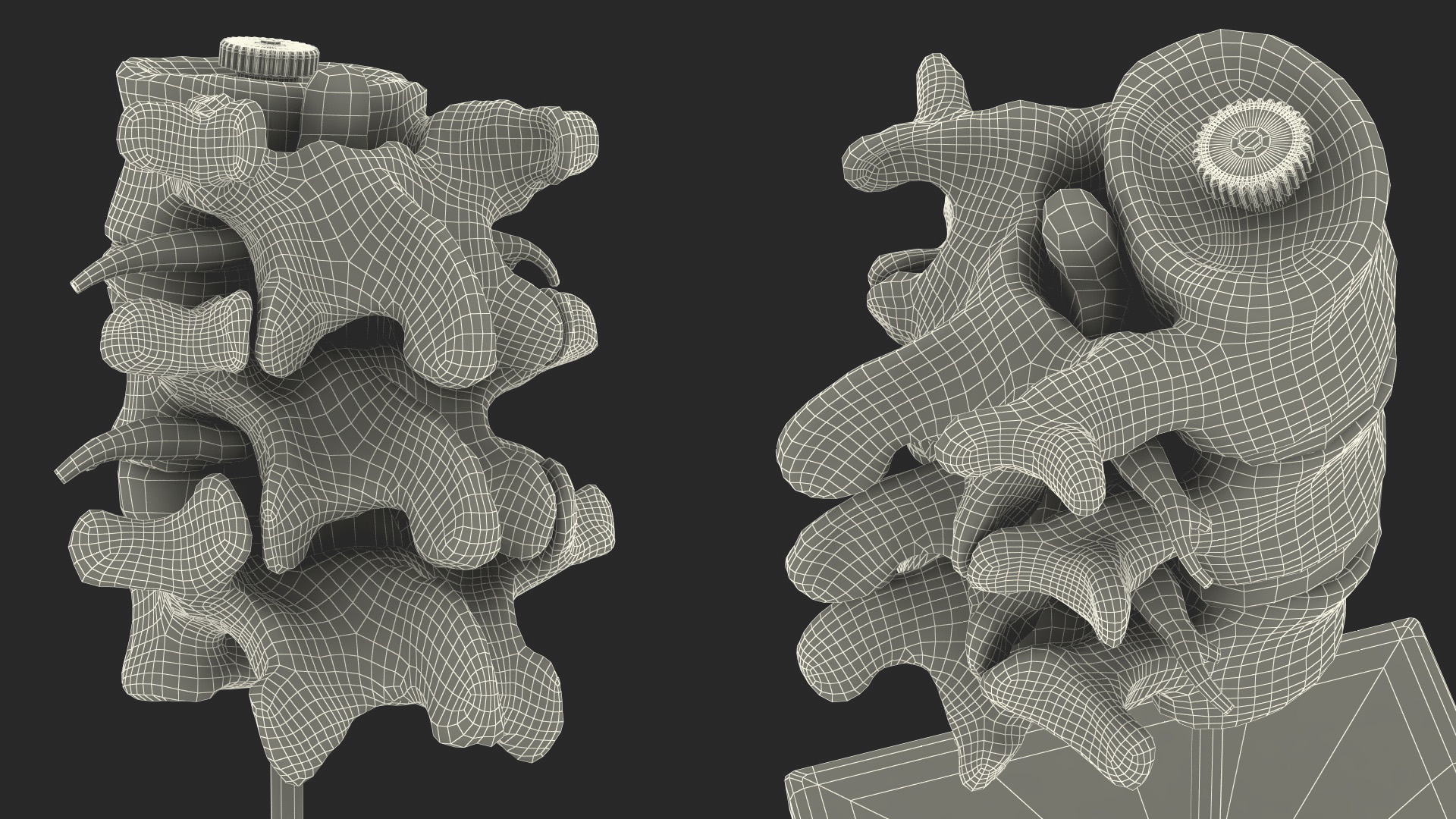 3D Herniated Vertebrae on Medical Stand