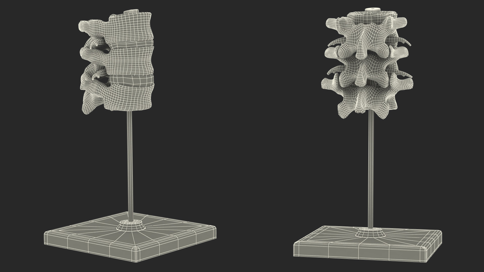 3D Herniated Vertebrae on Medical Stand