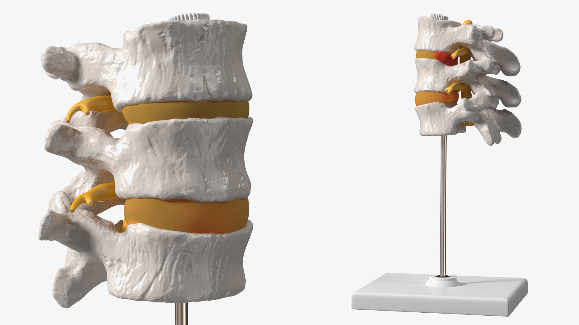3D Herniated Vertebrae on Medical Stand