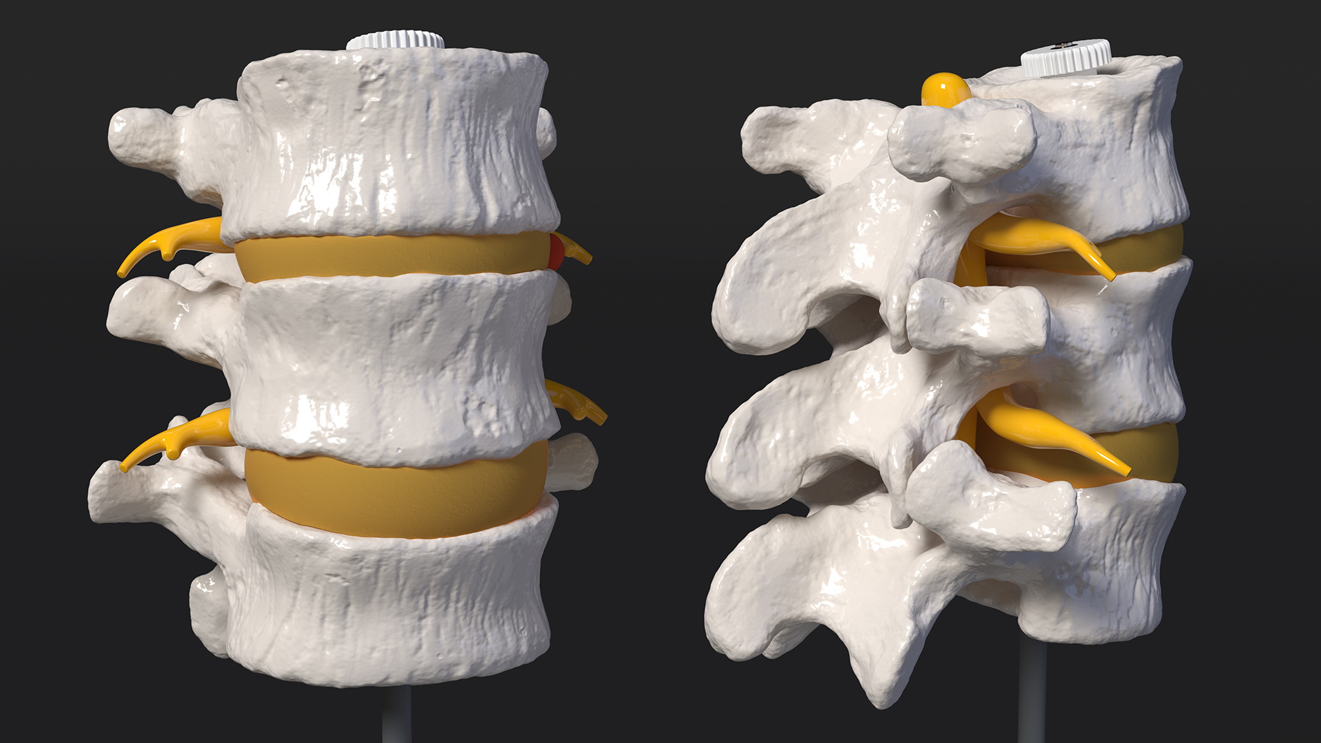 3D Herniated Vertebrae on Medical Stand