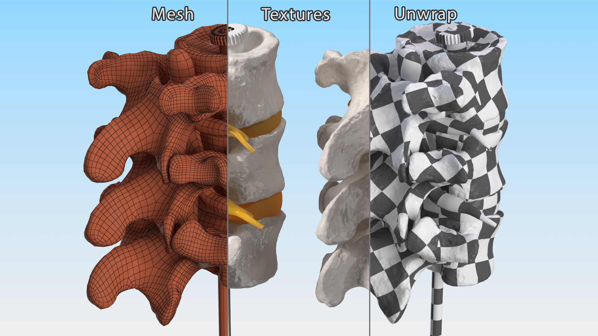 3D Herniated Vertebrae on Medical Stand