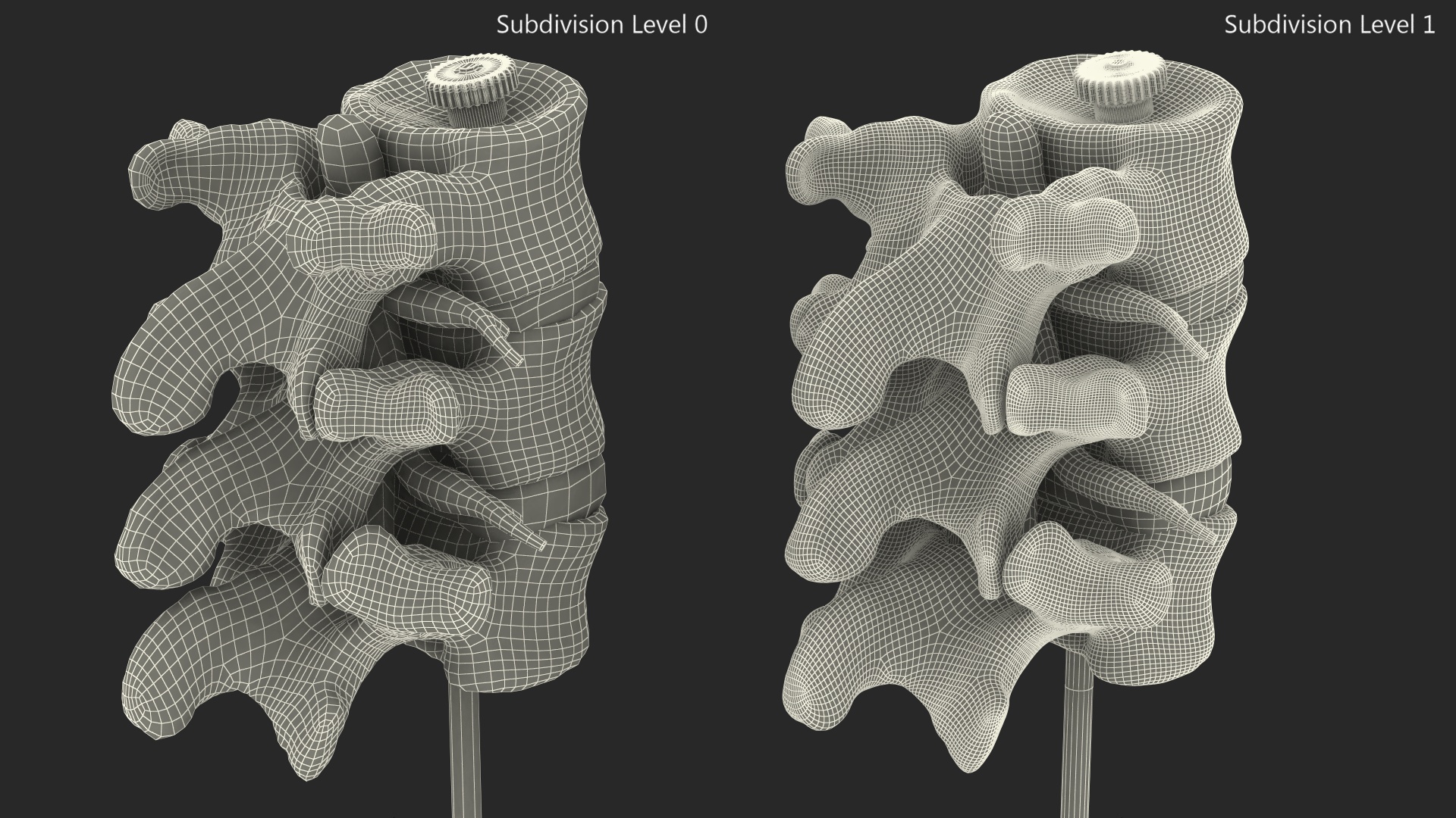 3D Herniated Vertebrae on Medical Stand