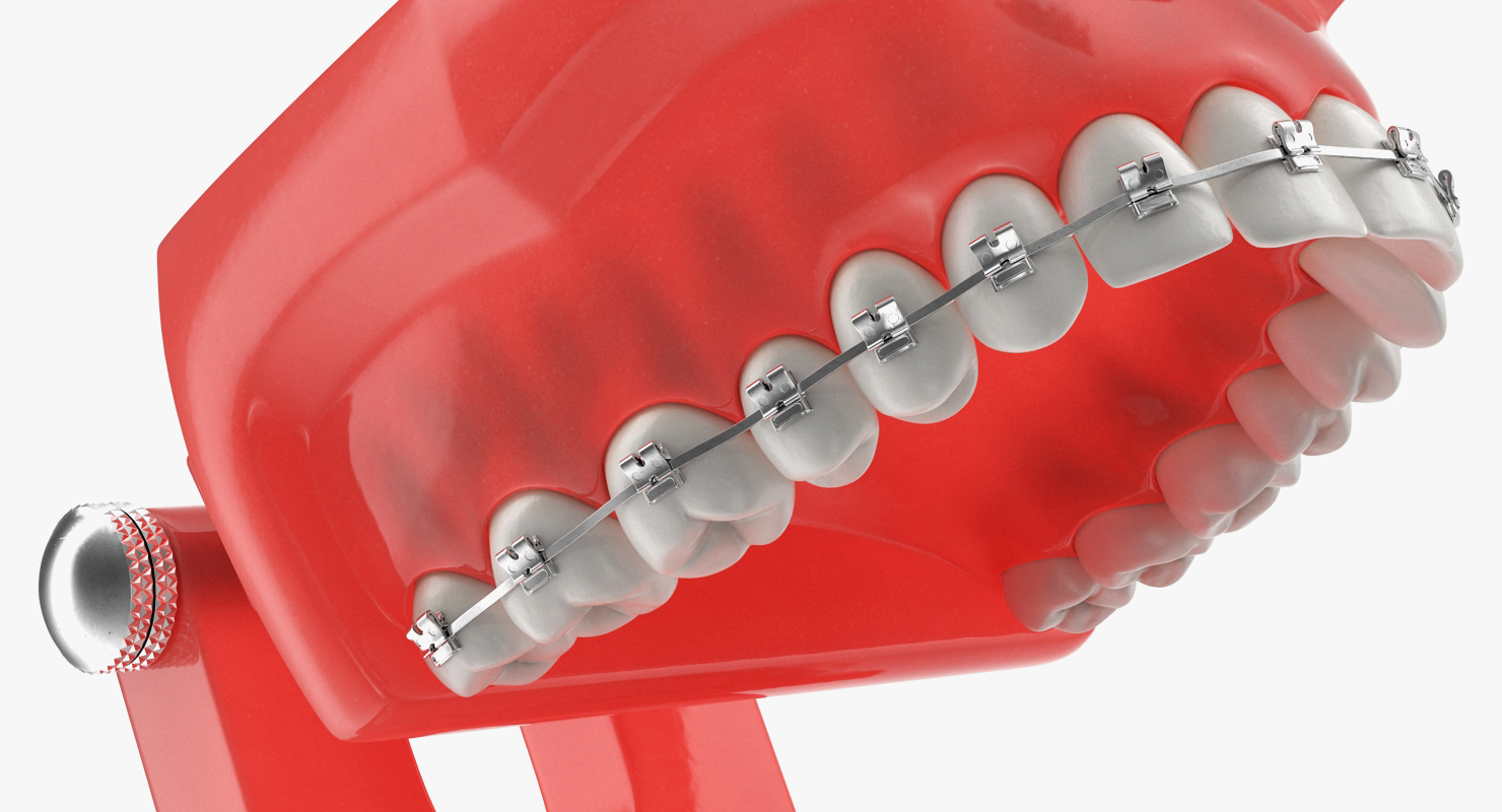 Typodont Teeth Model with Brackets 3D model