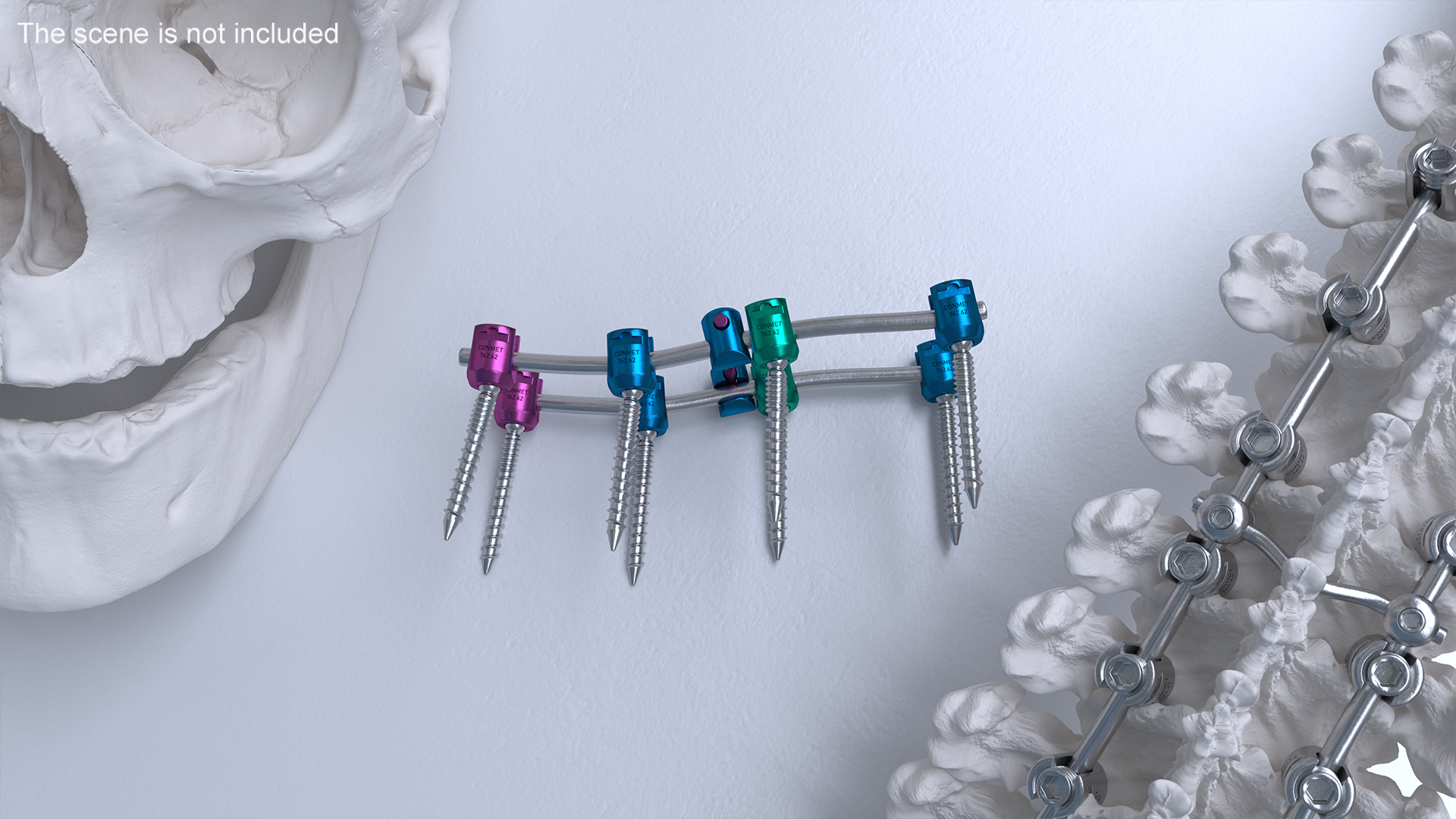 3D model Lumbar Cervical Spine Fixation System Colored