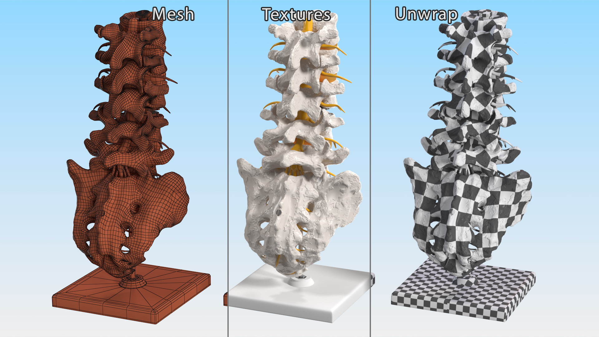 3D Intervertebral Disc Implant Installed on Spine