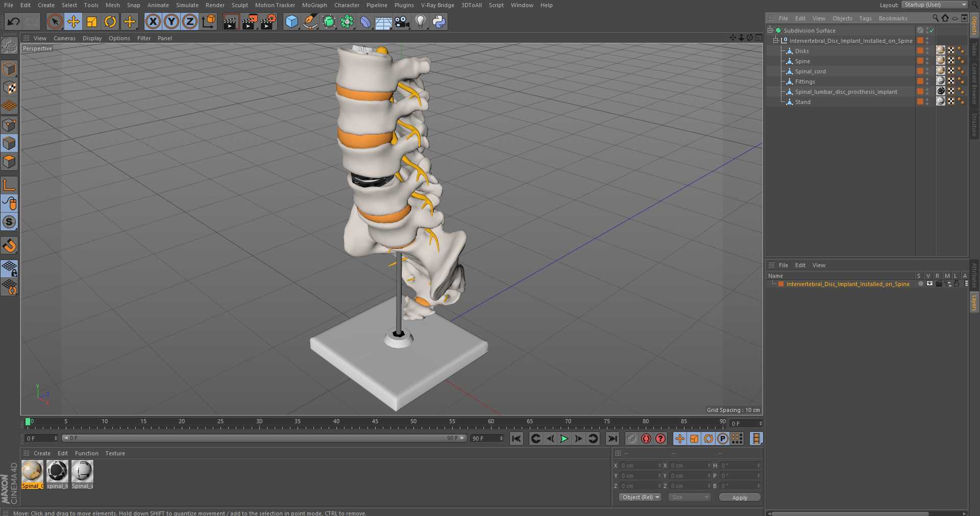 3D Intervertebral Disc Implant Installed on Spine