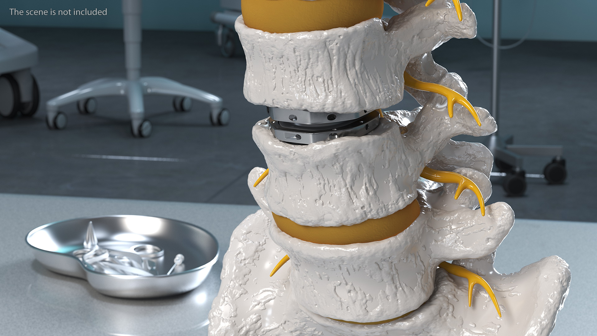 3D Intervertebral Disc Implant Installed on Spine