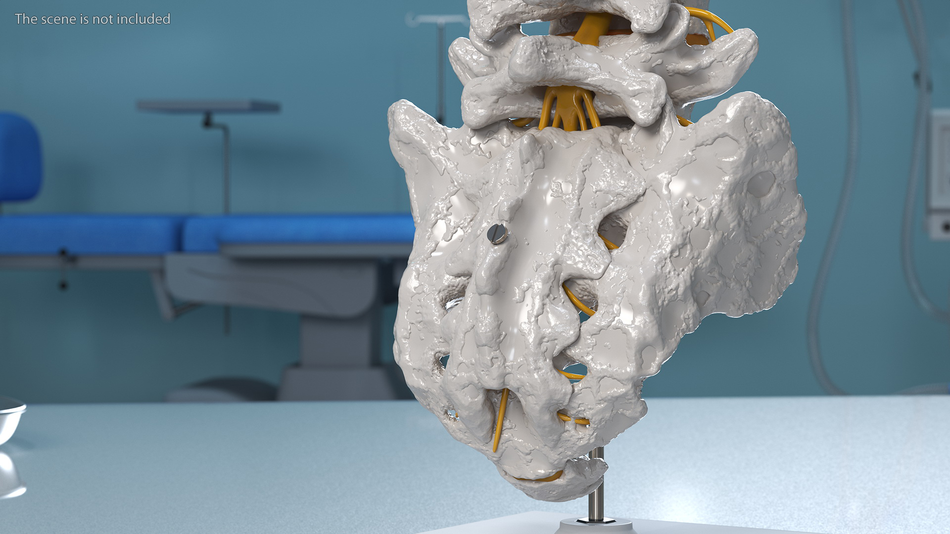 3D Intervertebral Disc Implant Installed on Spine