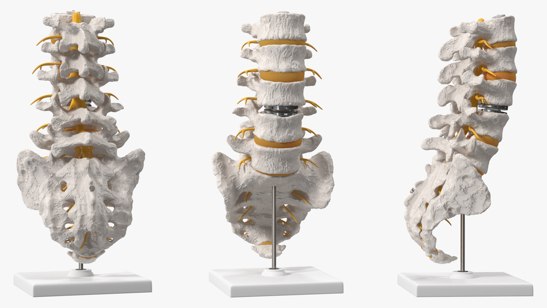 3D Intervertebral Disc Implant Installed on Spine