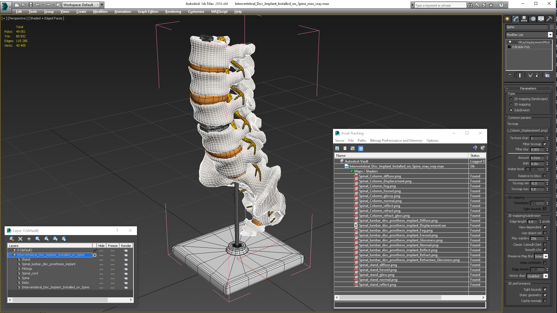 3D Intervertebral Disc Implant Installed on Spine
