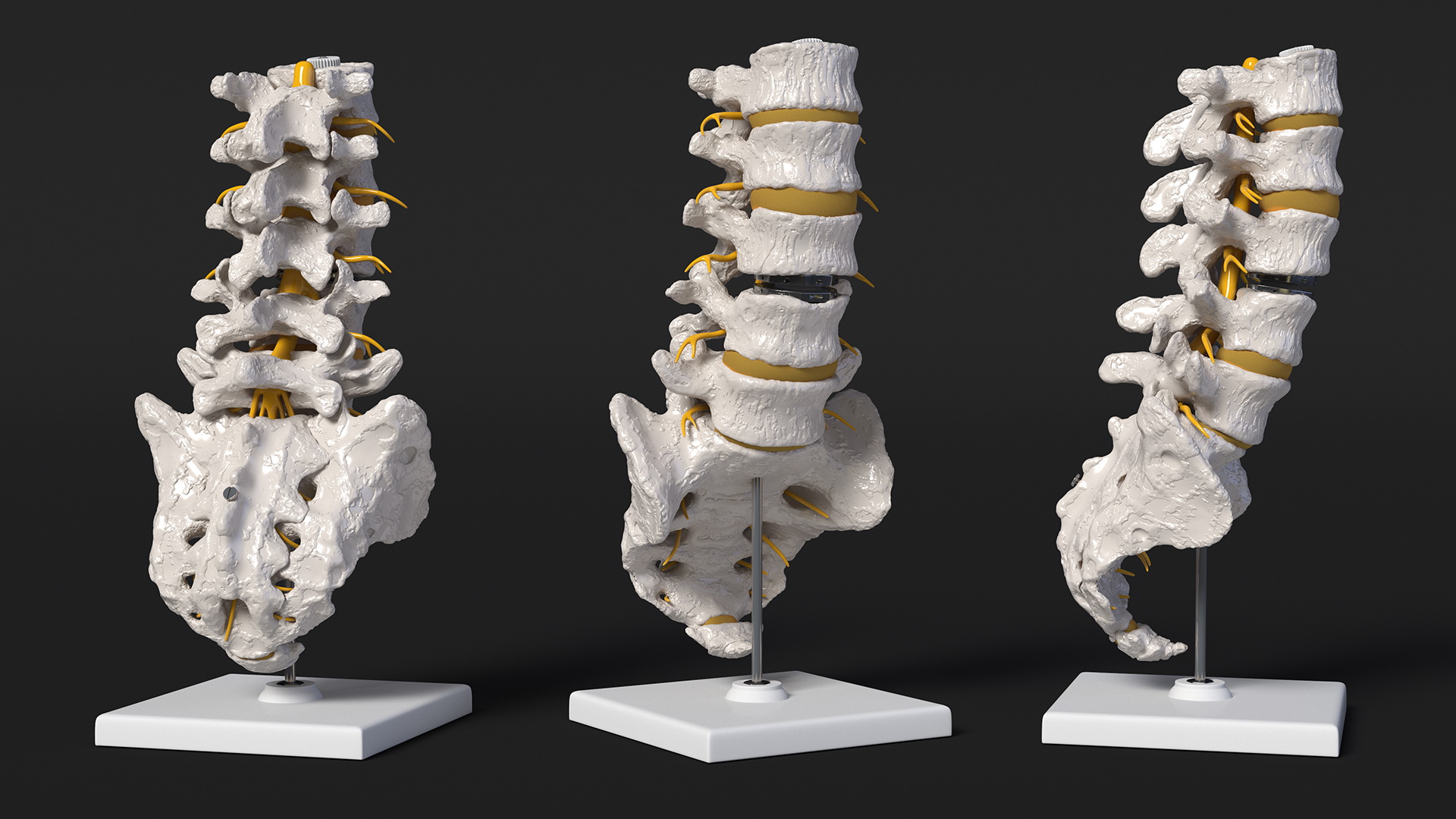 3D Intervertebral Disc Implant Installed on Spine