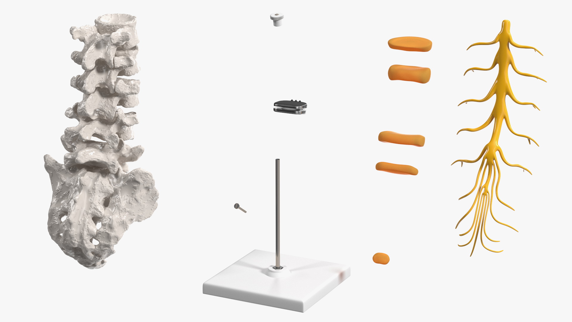 3D Intervertebral Disc Implant Installed on Spine