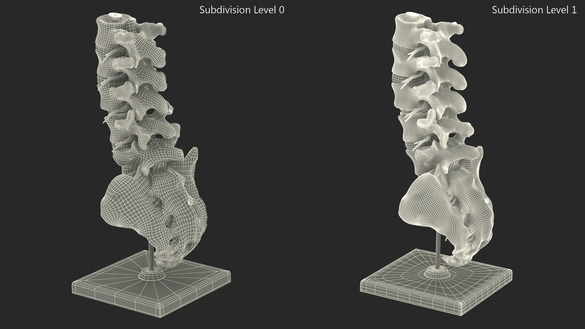 3D Intervertebral Disc Implant Installed on Spine