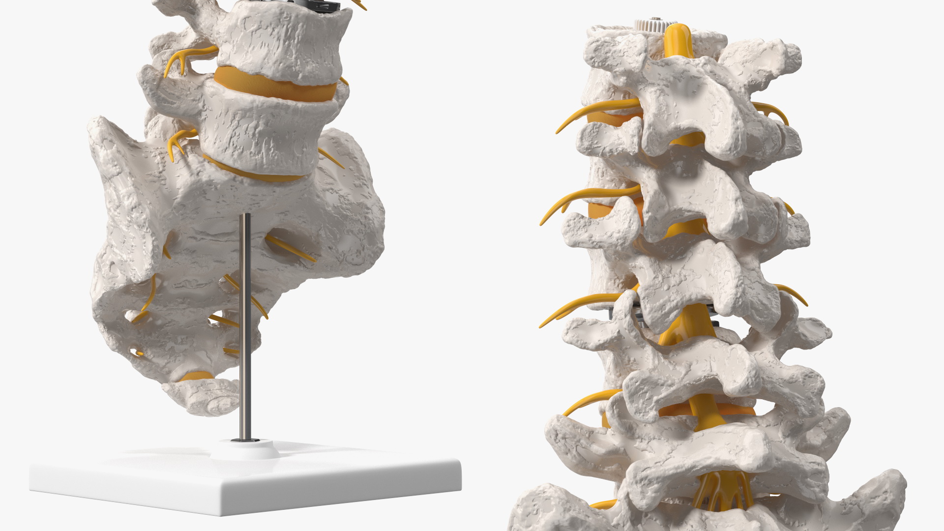 3D Intervertebral Disc Implant Installed on Spine