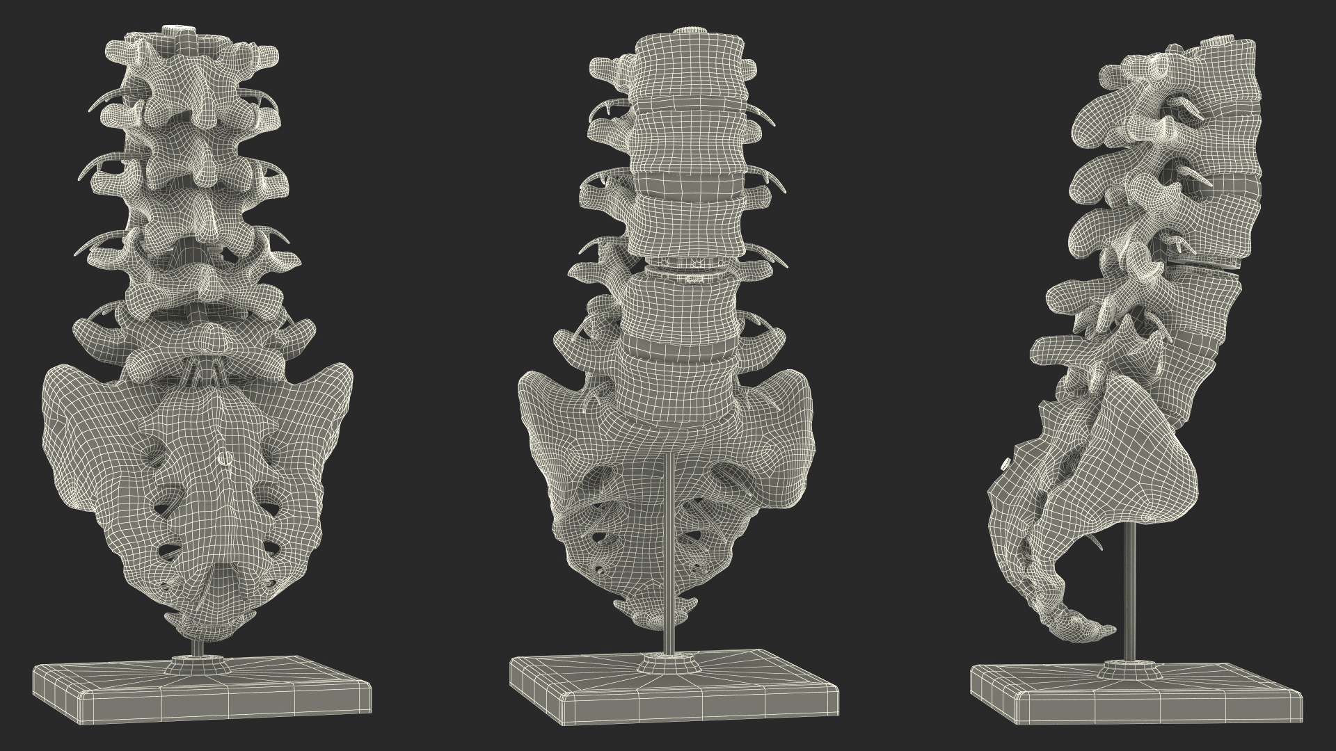 3D Intervertebral Disc Implant Installed on Spine