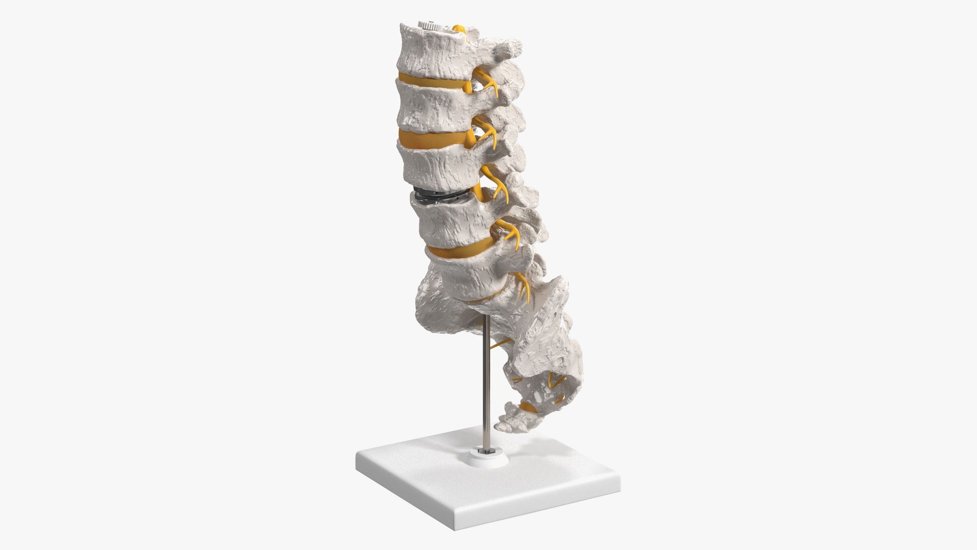 3D Intervertebral Disc Implant Installed on Spine