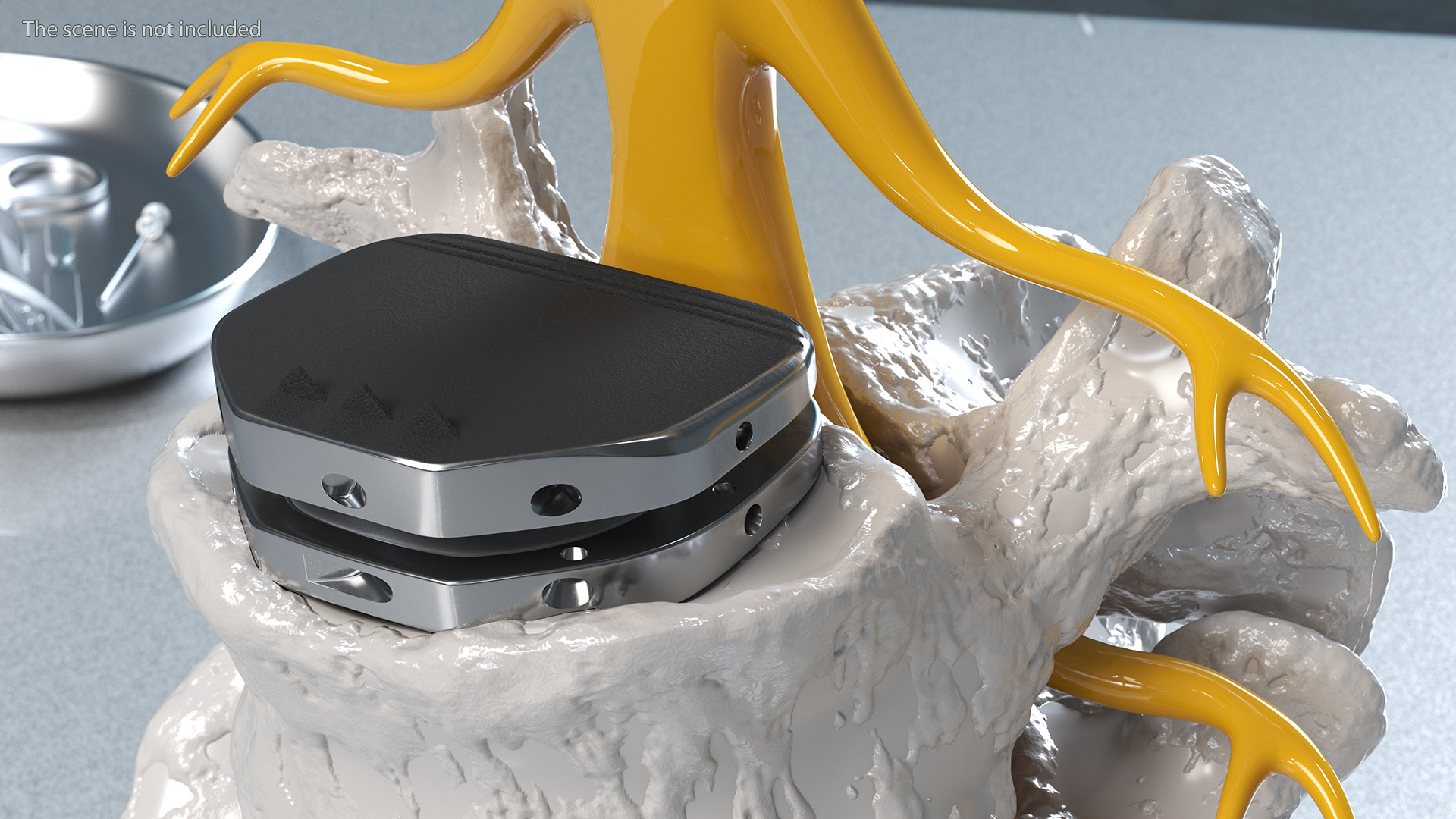 3D Intervertebral Disc Implant Installed on Spine