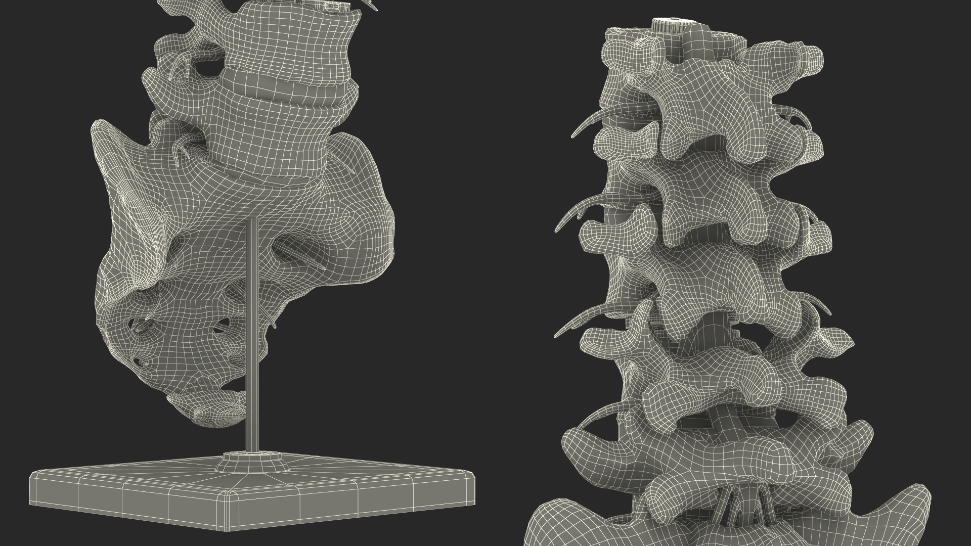 3D Intervertebral Disc Implant Installed on Spine