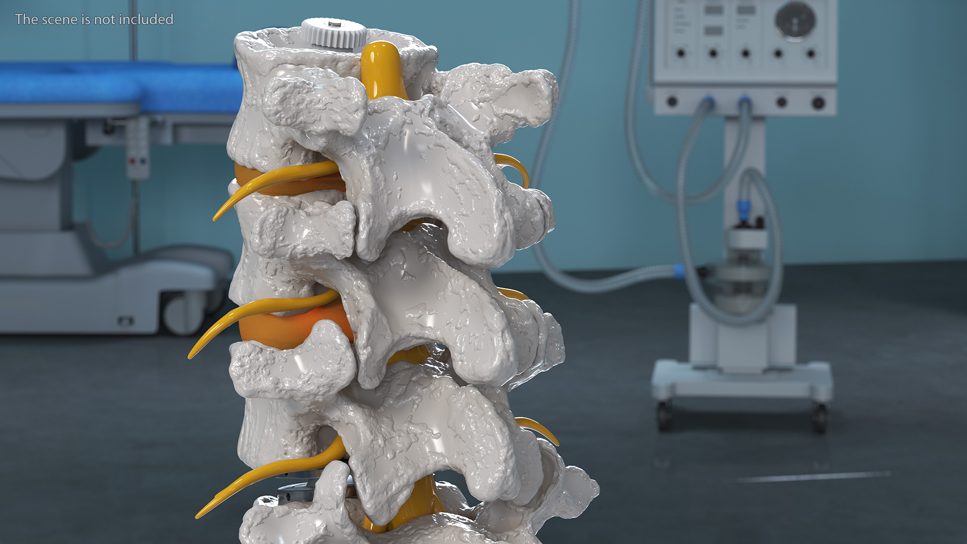 3D Intervertebral Disc Implant Installed on Spine