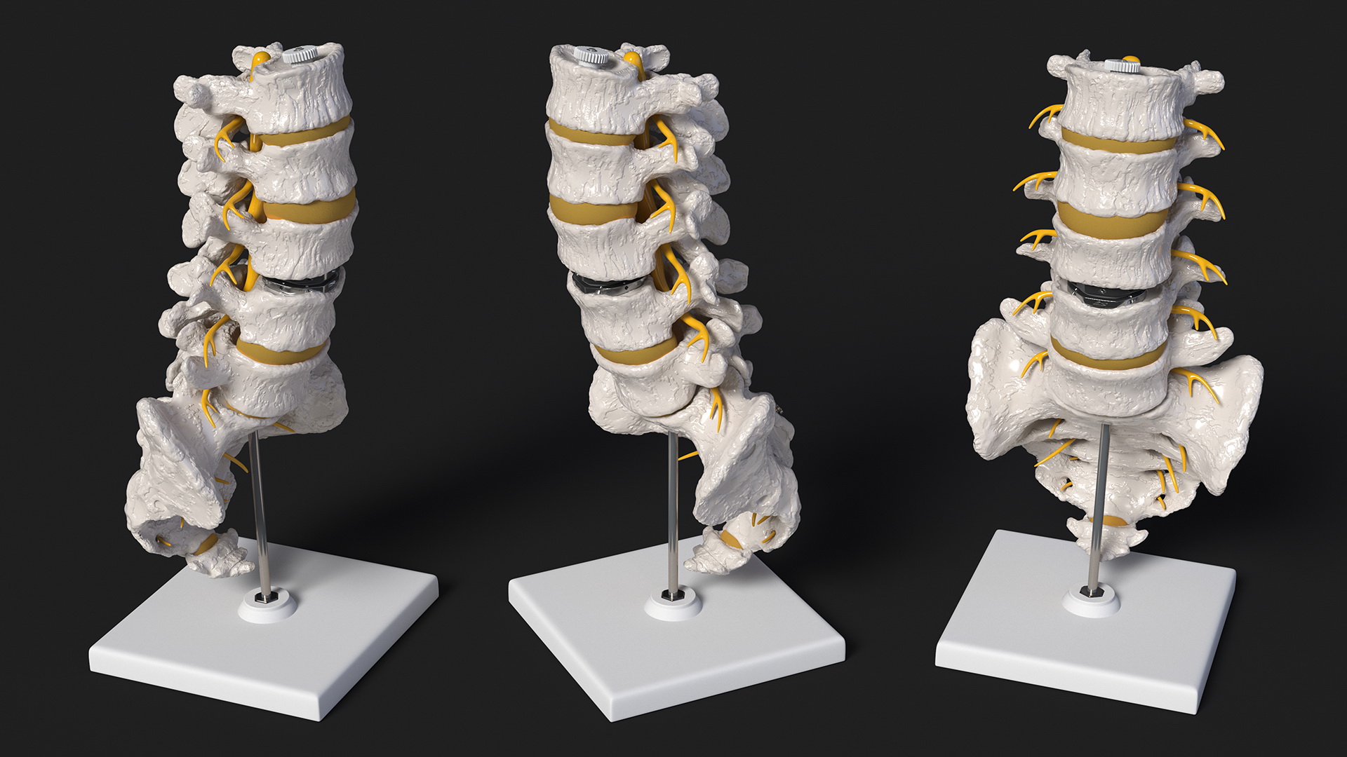 3D Intervertebral Disc Implant Installed on Spine