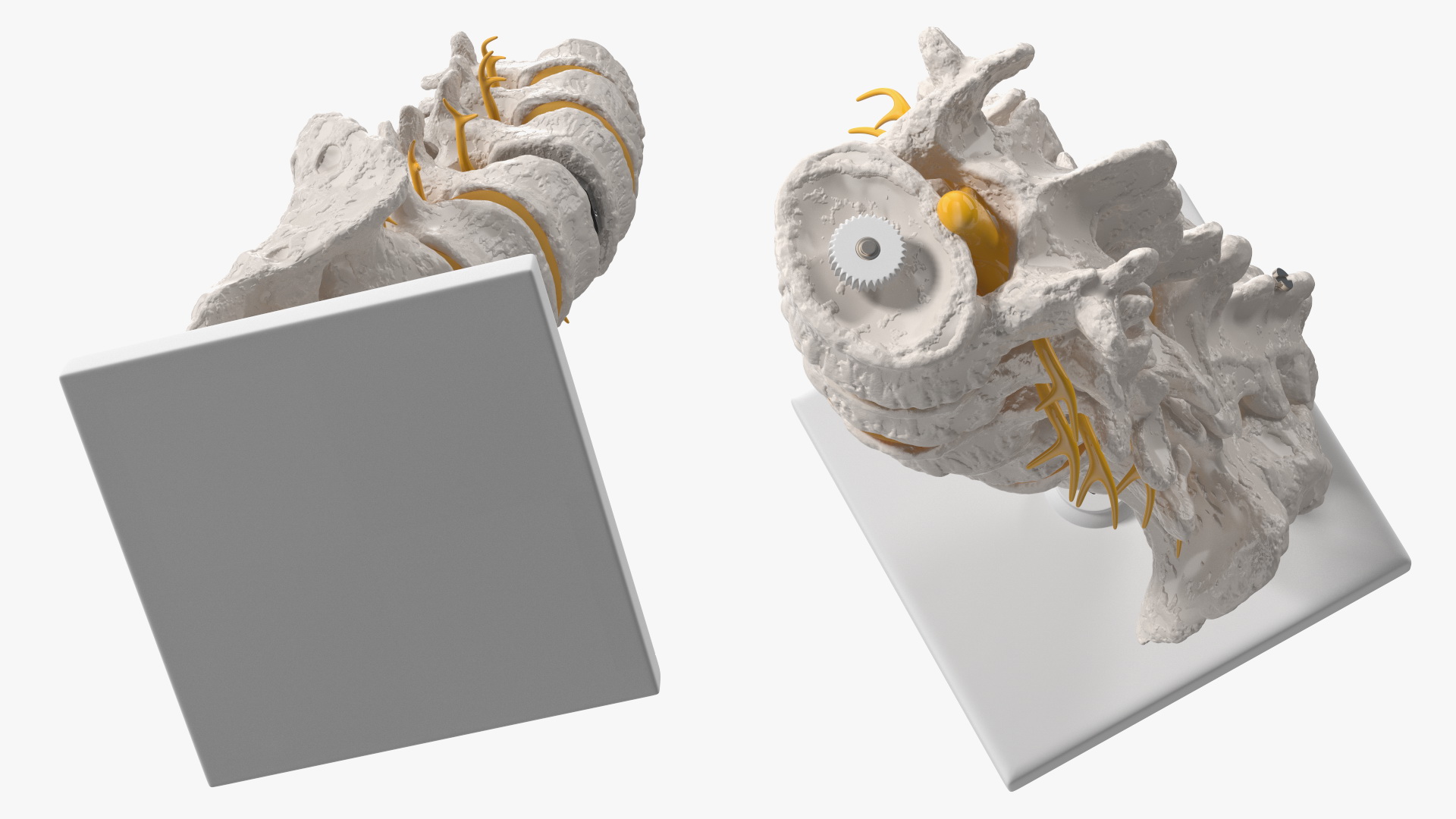 3D Intervertebral Disc Implant Installed on Spine