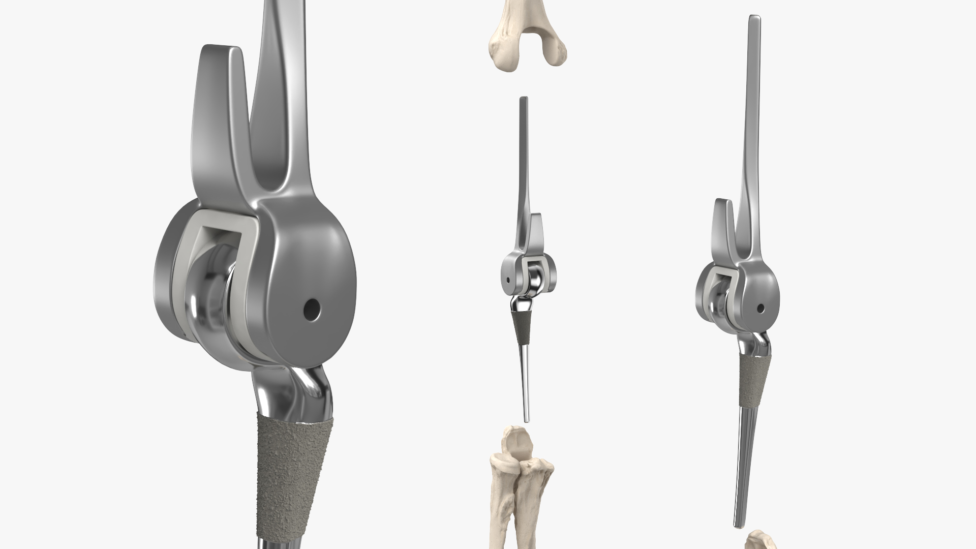Elbow Joint Implant with Humerus and Ulna, view 3