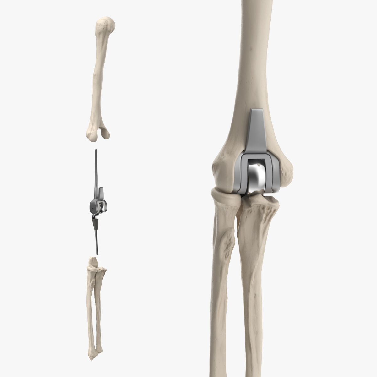 Elbow Joint Implant with Humerus and Ulna
