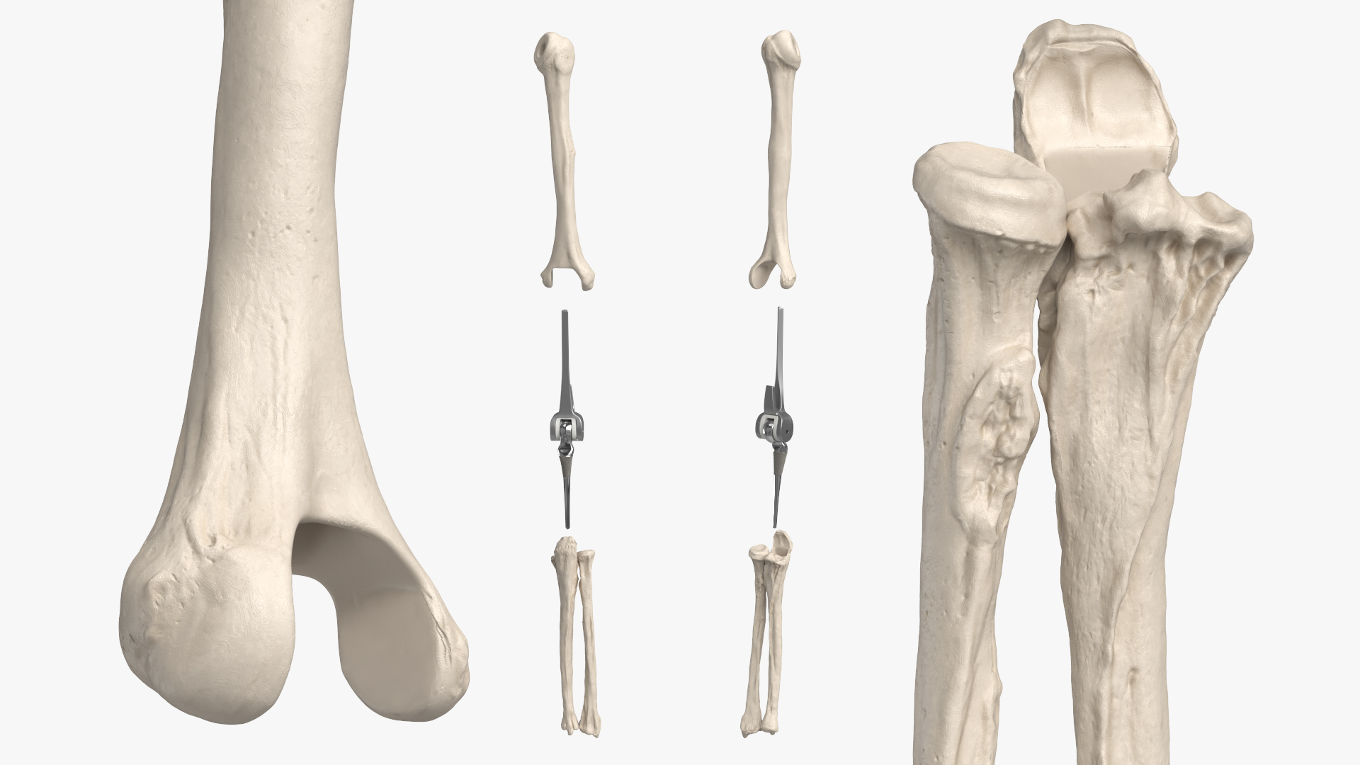 Elbow Joint Implant with Humerus and Ulna, view 4