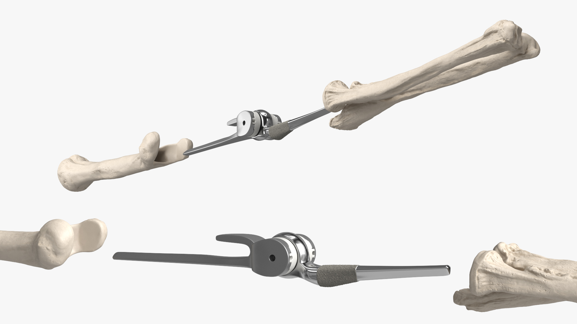 Elbow Joint Implant with Humerus and Ulna, view 5