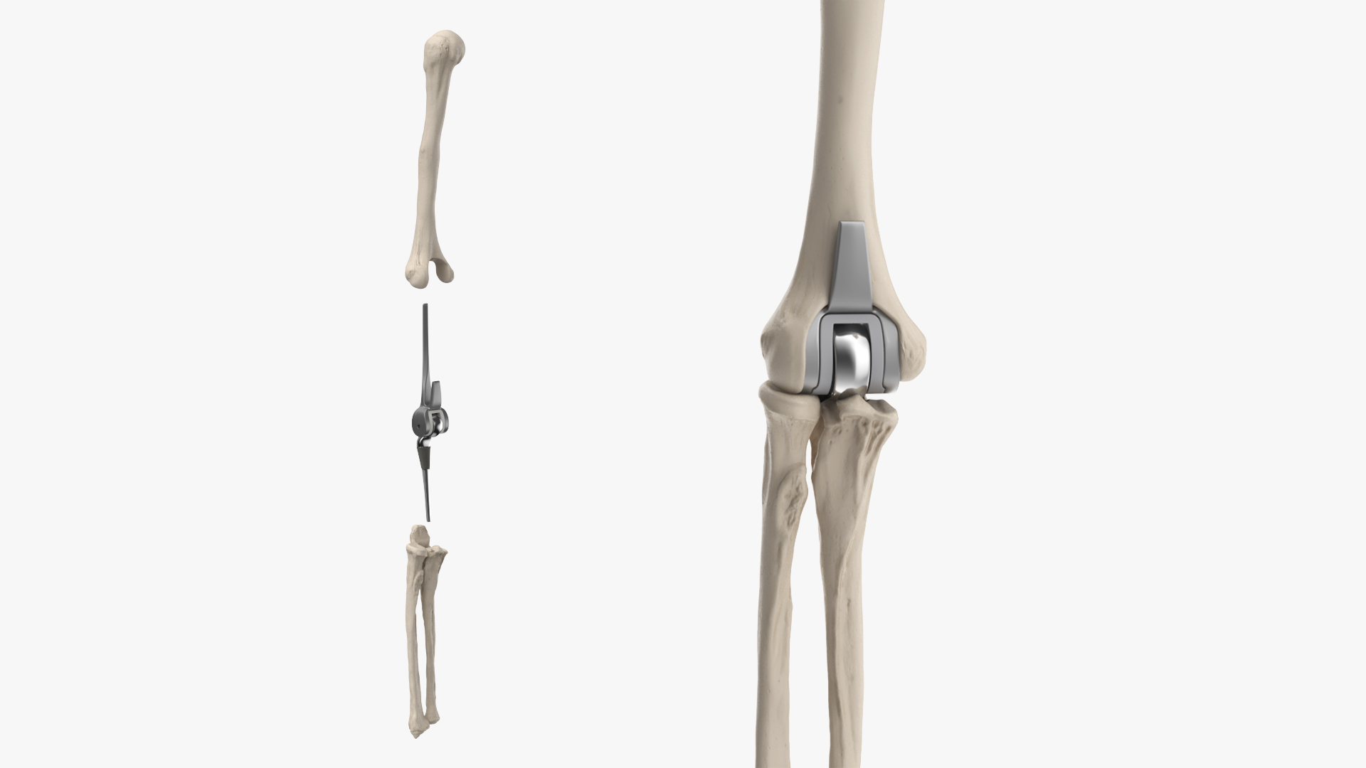 Elbow Joint Implant with Humerus and Ulna