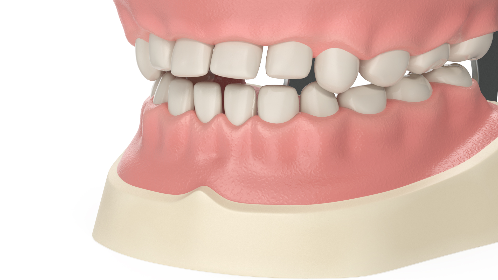 3D Dental Anatomy Educational Pediatric Kit with Removable Open Bite Teeth