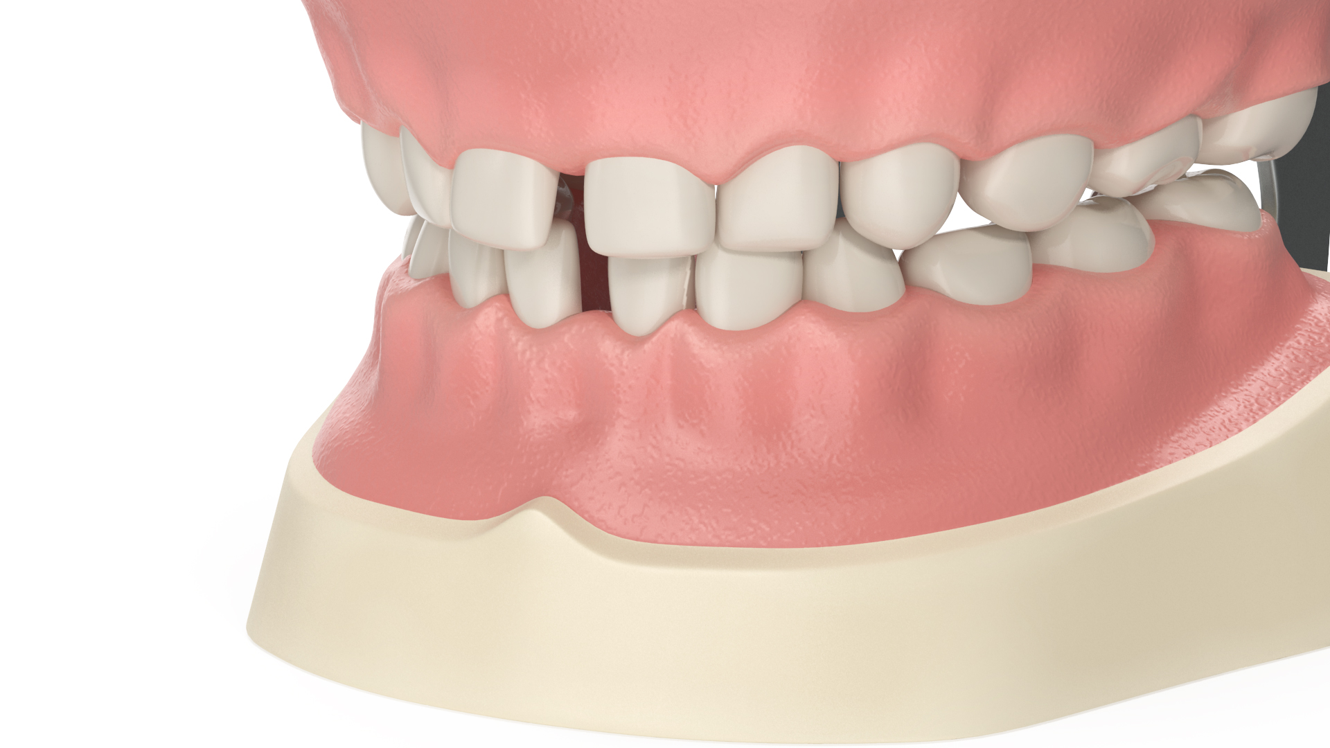 3D Pediatric Typodont Demonstration Model with Removable Gapped Teeth
