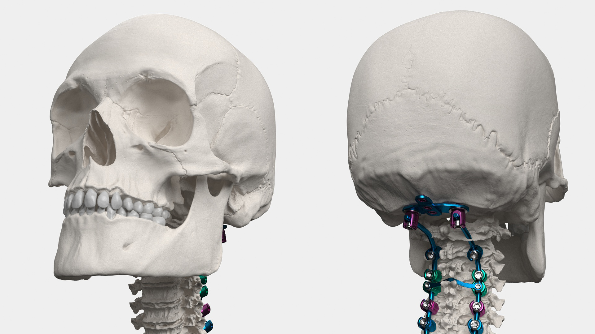 3D Bone Skull and Cervical Spine Fixation Colored