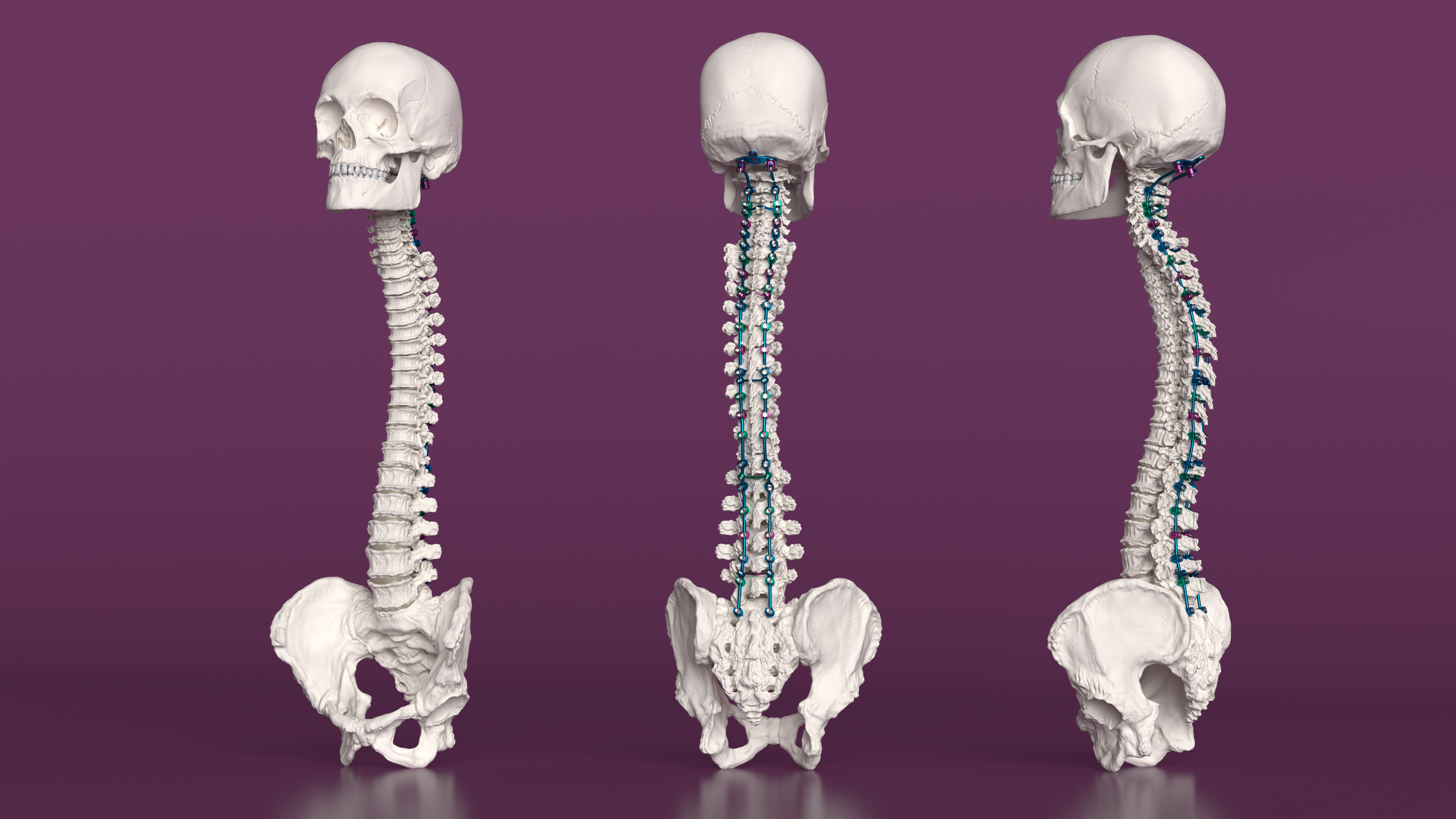 3D Bone Skull and Cervical Spine Fixation Colored