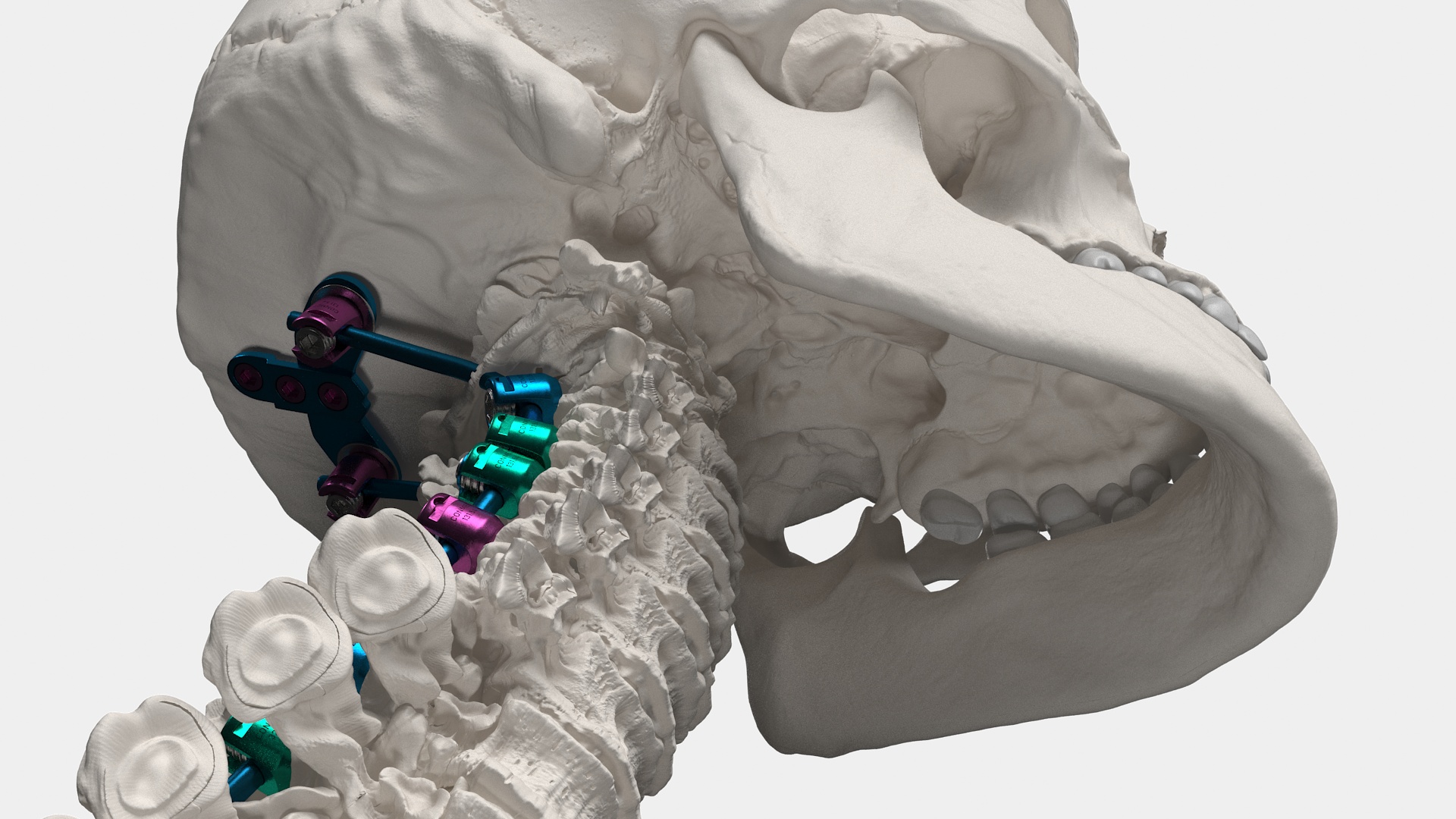 3D Bone Skull and Cervical Spine Fixation Colored