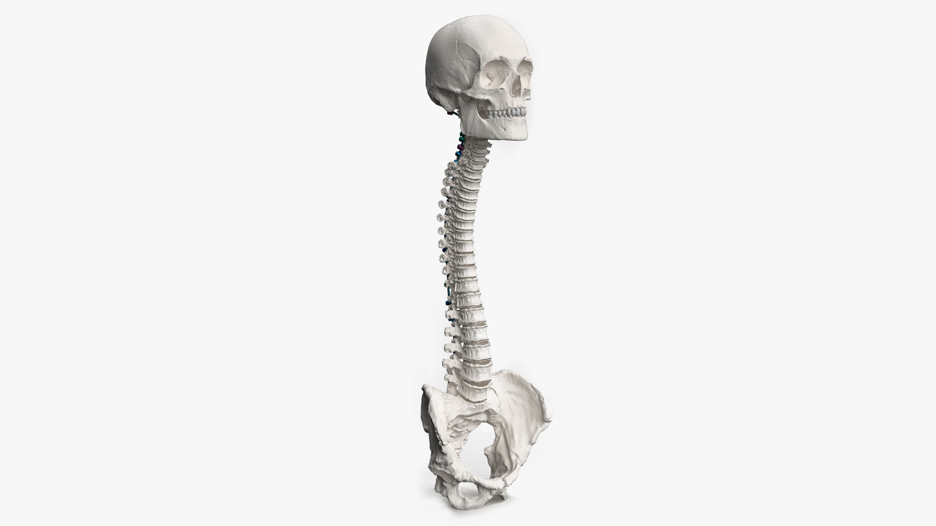 3D Bone Skull and Cervical Spine Fixation Colored