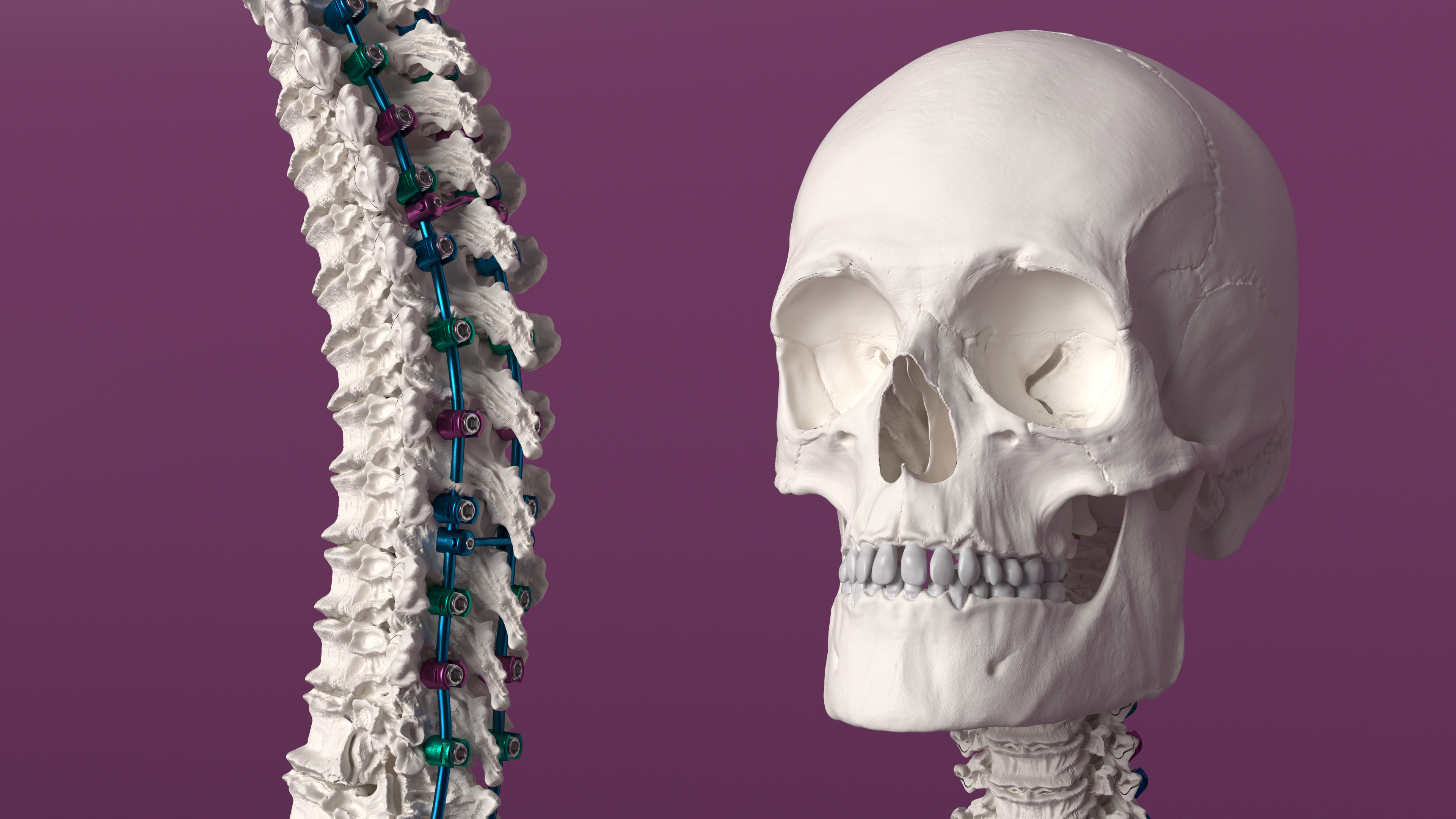 3D Bone Skull and Cervical Spine Fixation Colored