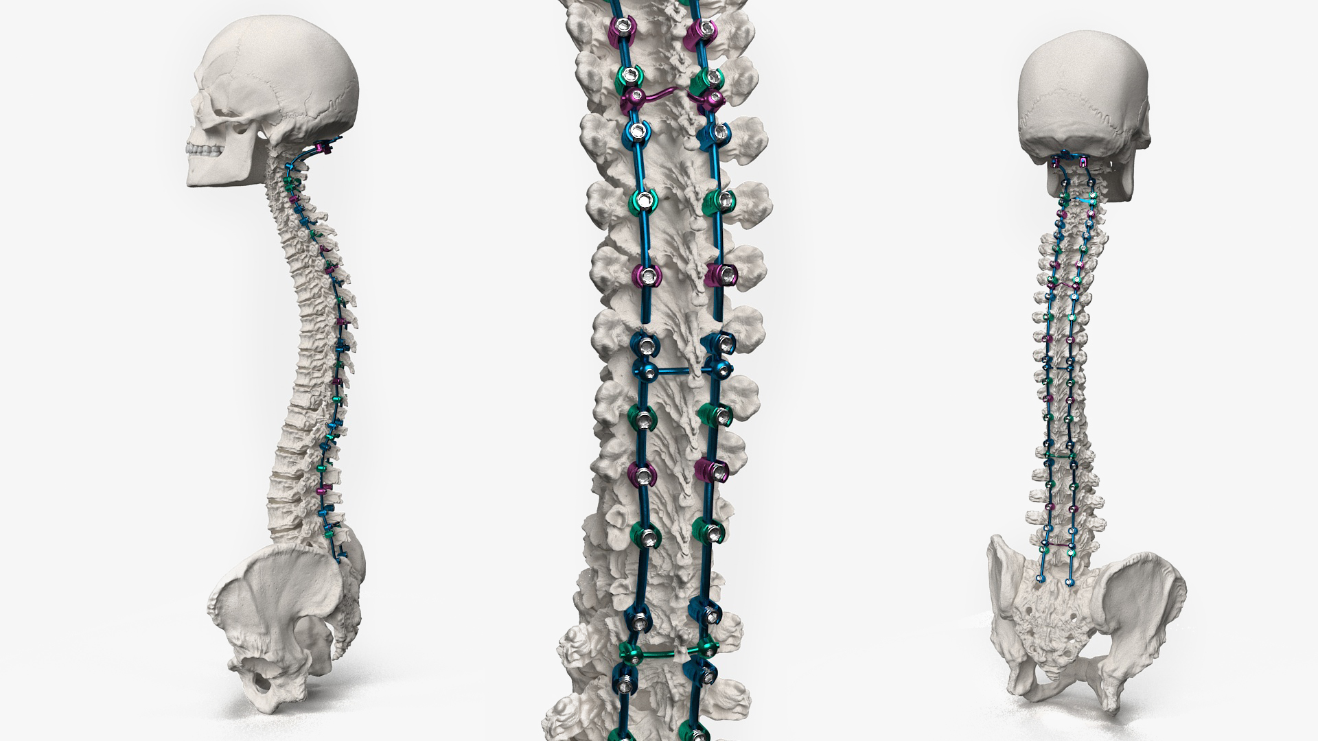 3D Bone Skull and Cervical Spine Fixation Colored