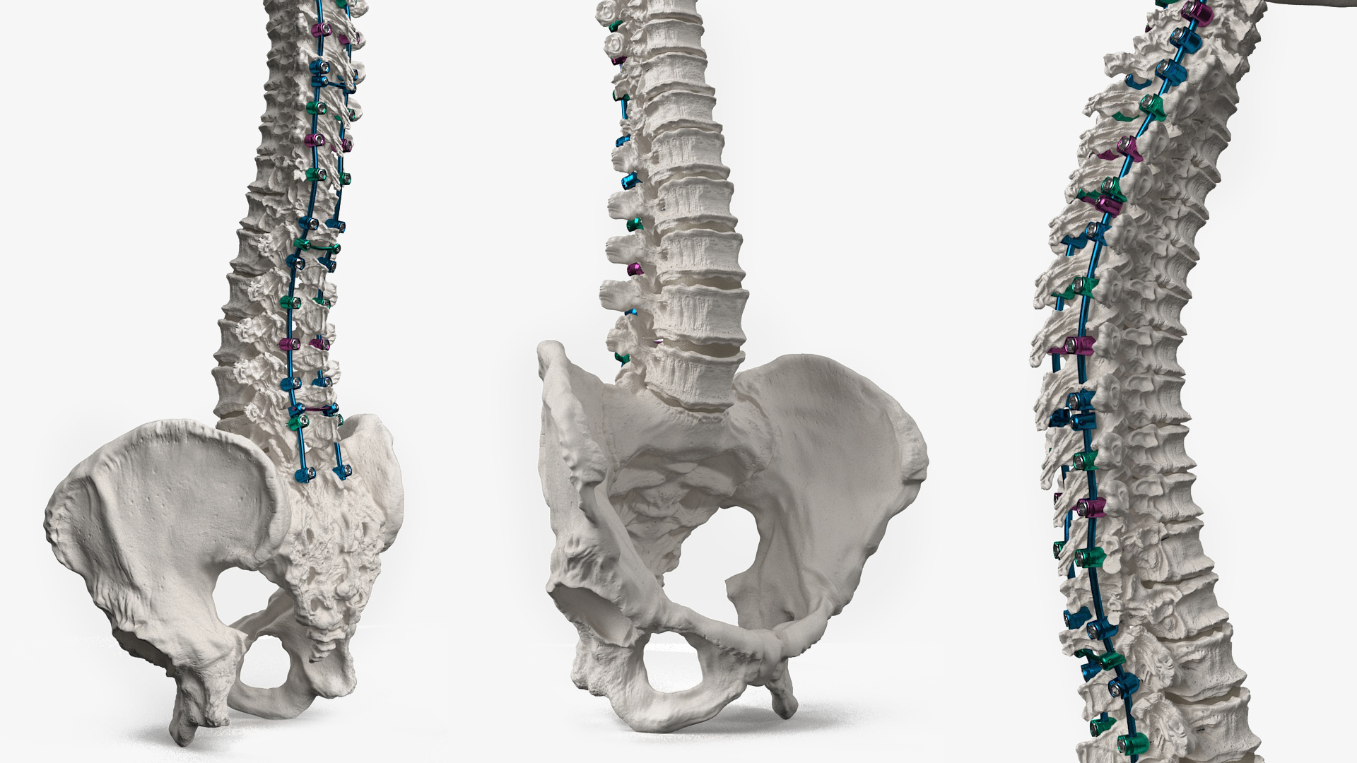 3D Bone Skull and Cervical Spine Fixation Colored
