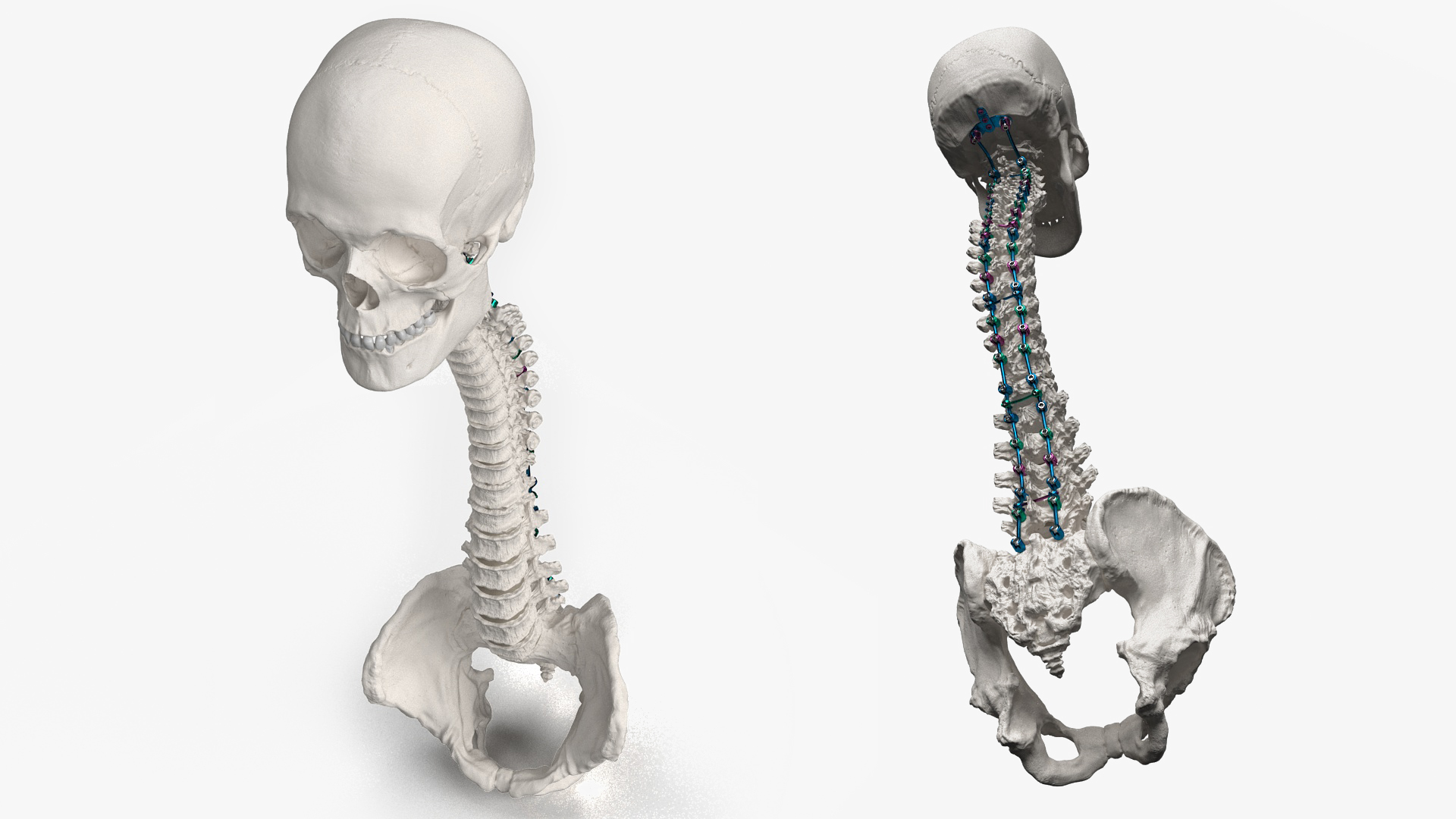 3D Bone Skull and Cervical Spine Fixation Colored