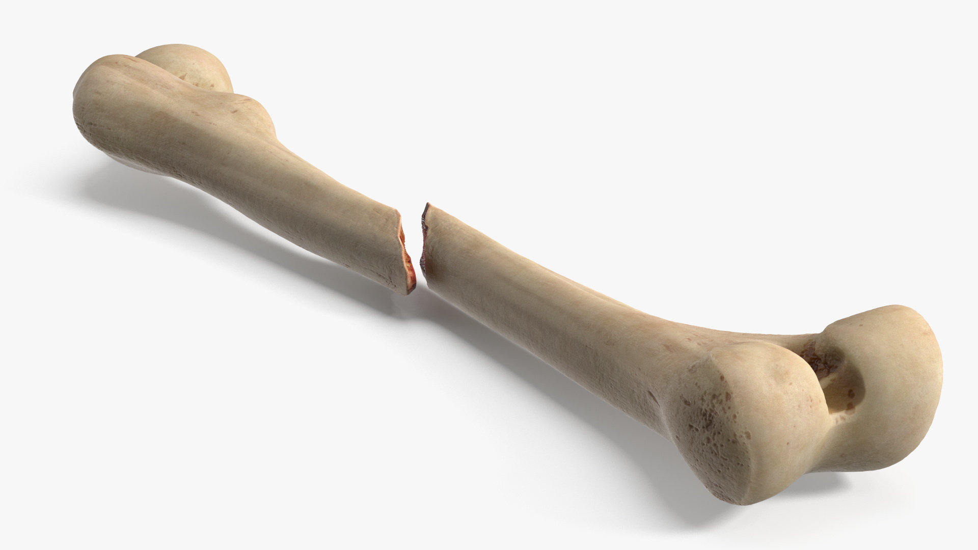 Femur Bone with Complete Fracture - view 6
