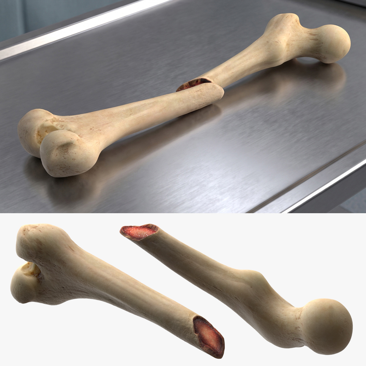 Femur Bone with Complete Fracture 3D model preview