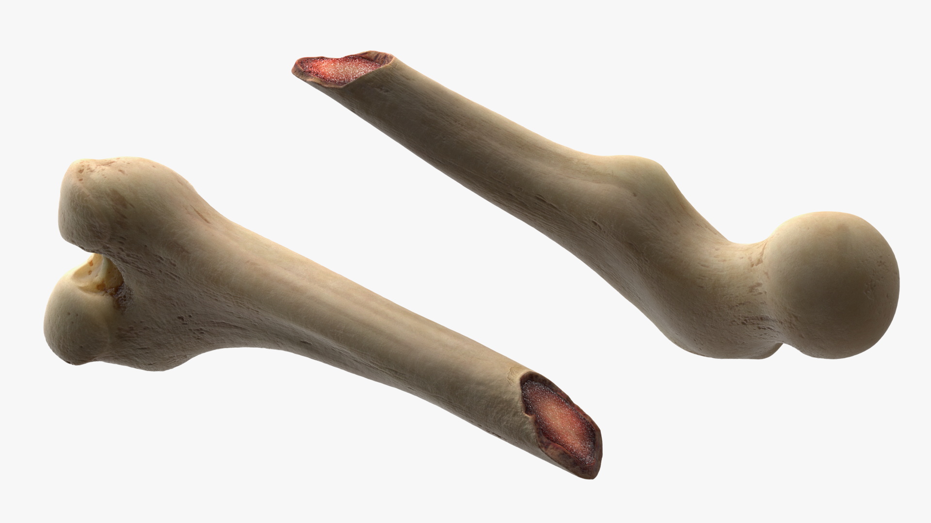 Femur Bone with Complete Fracture - view 7