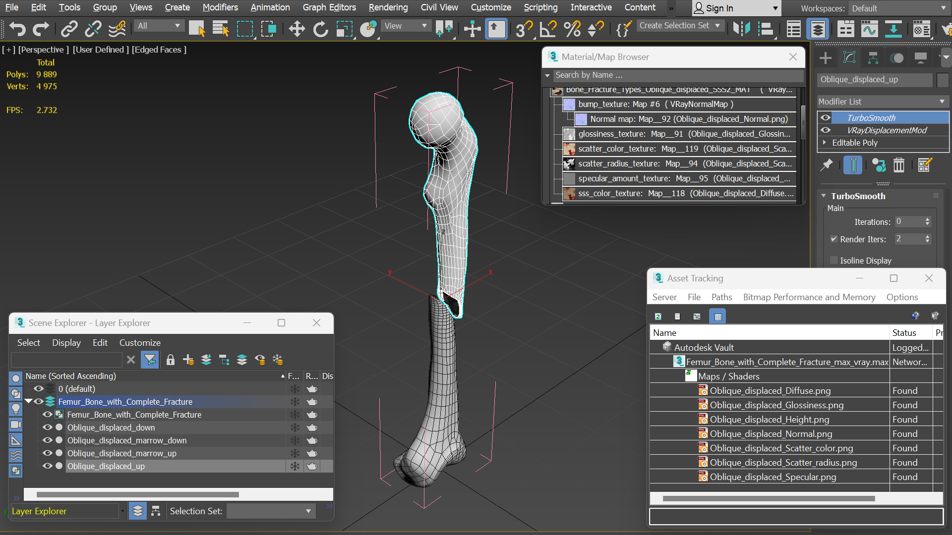 Femur Bone with Complete Fracture - view 12
