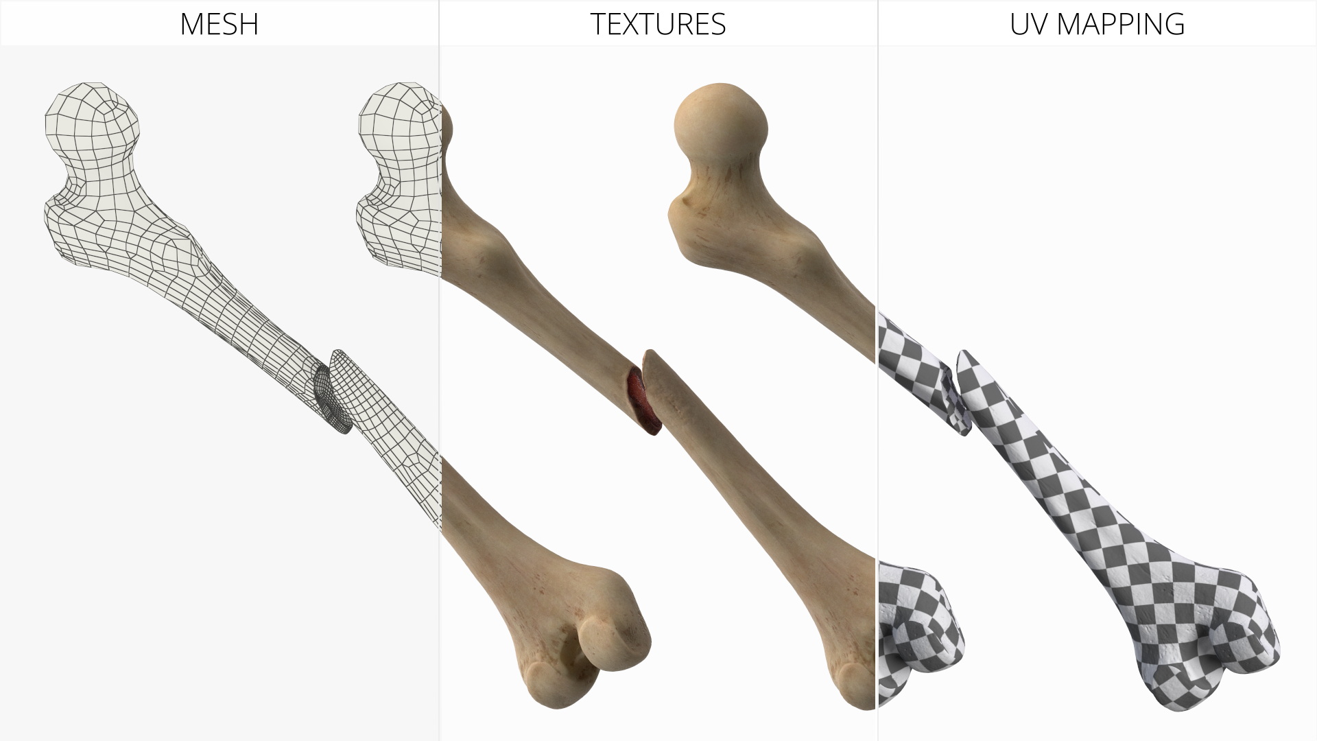 Femur Bone with Complete Fracture - view 8