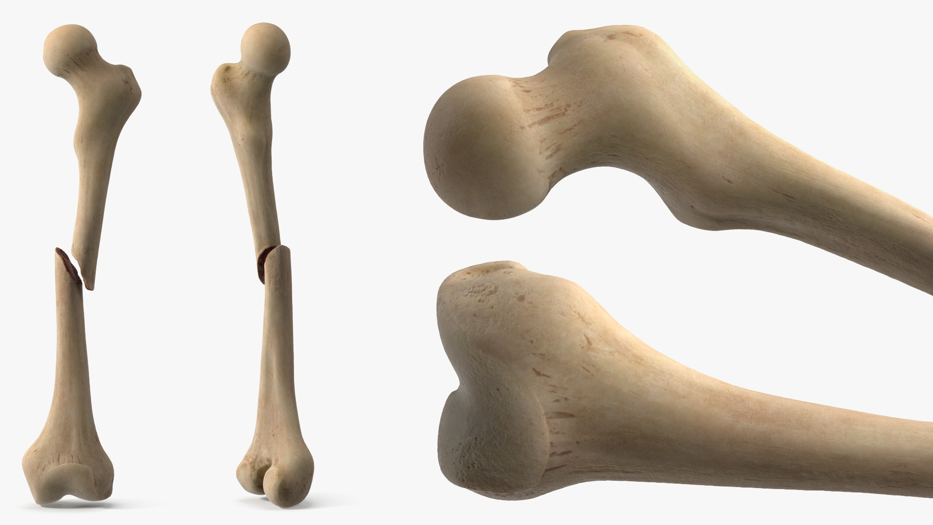 Femur Bone with Complete Fracture - view 4