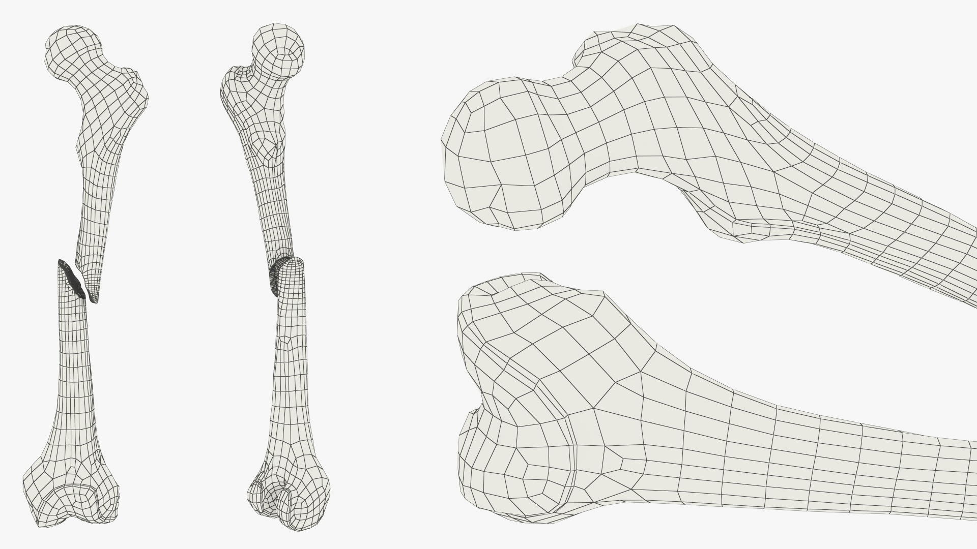 Femur Bone with Complete Fracture - view 9