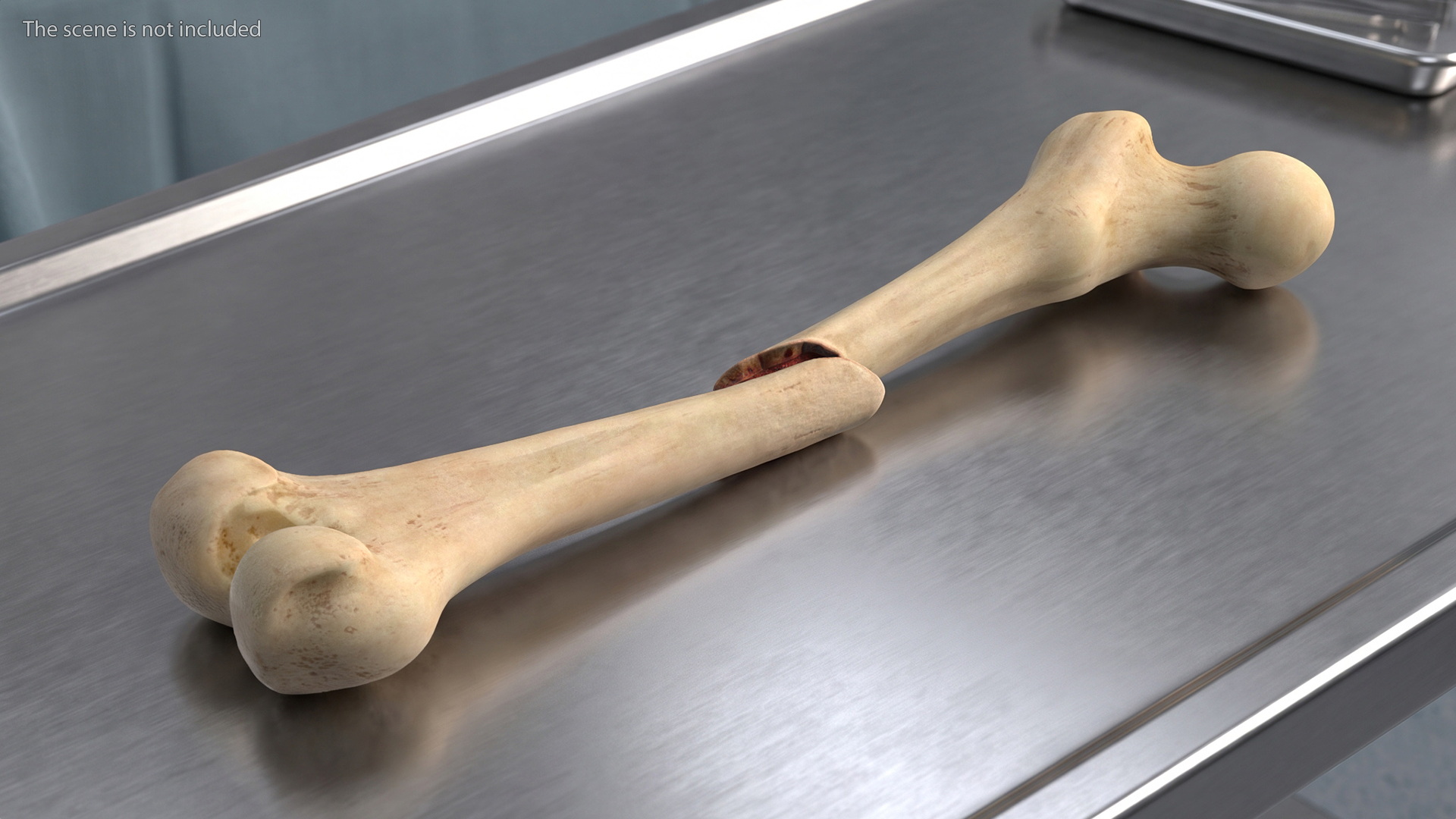 Femur Bone with Complete Fracture - view 2
