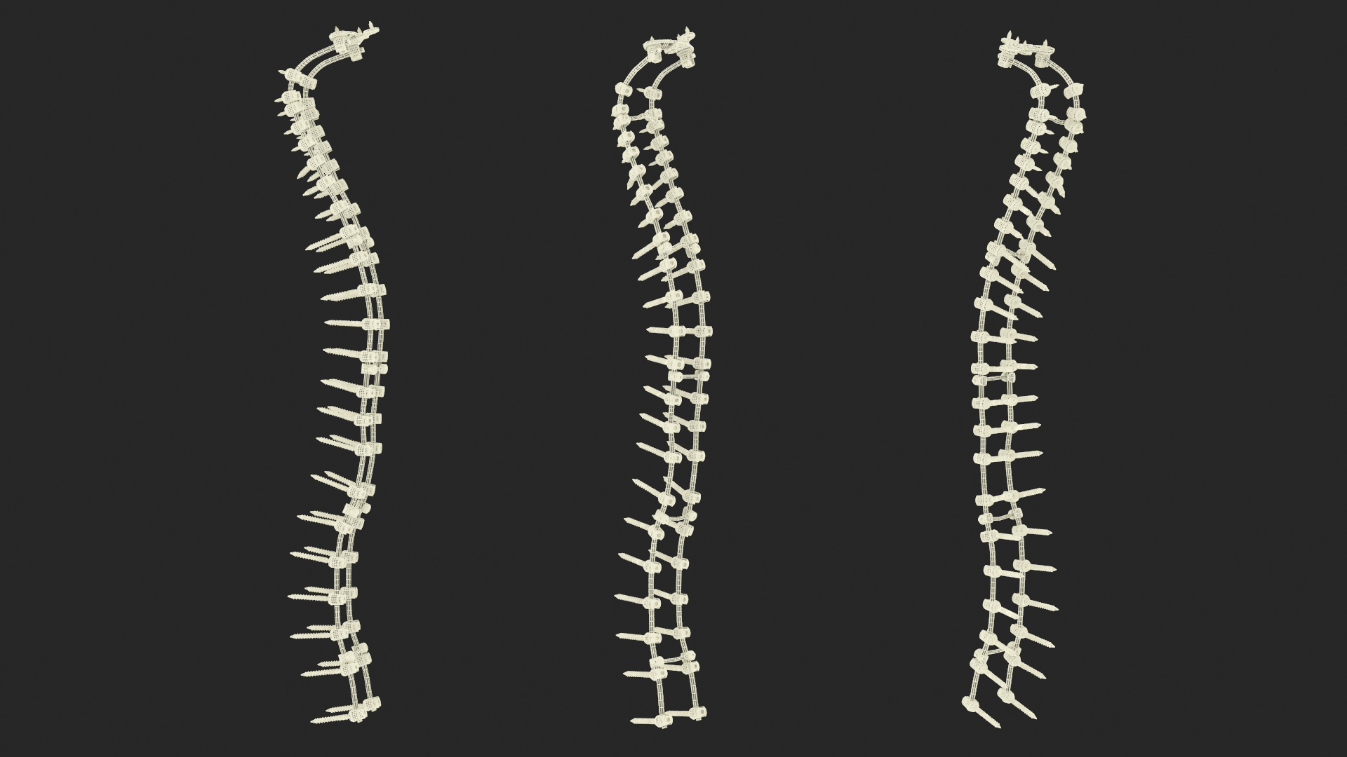 Spine Fixation System Colored 3D model